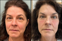 Load image into Gallery viewer, Ariessence pure PDGF+ treatment.