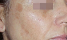 Load image into Gallery viewer, The Cosmelan® Method for Hyperpigmentation