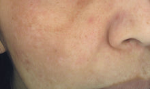 Load image into Gallery viewer, The Cosmelan® Method for Hyperpigmentation