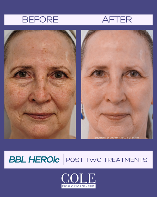 Reverse the Signs of Sun Damage: How BBL & Laser Therapy Transform Thick, Wrinkled Skin