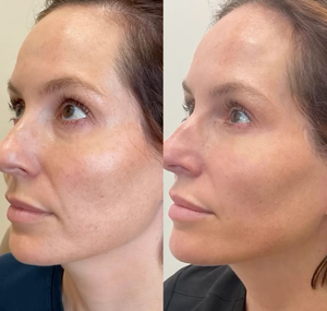 ariessence pure PDGF+ treatment.