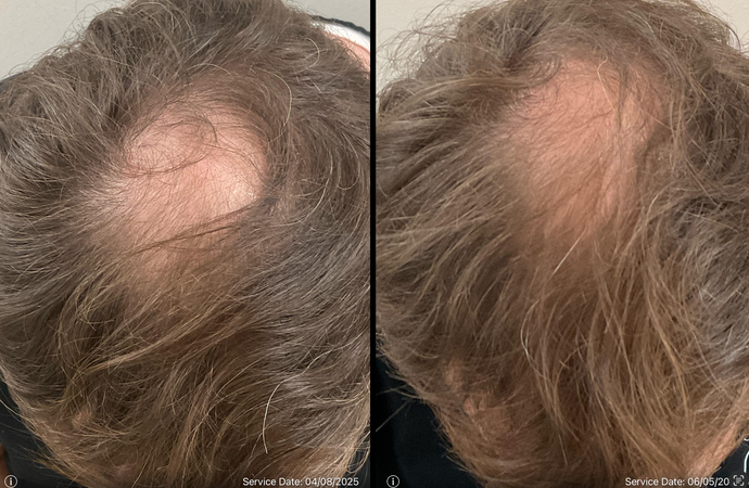 ariessence pure PDGF+ treatment.