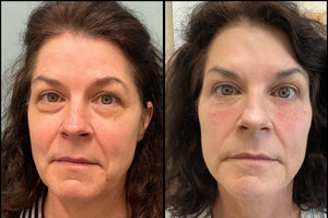 ariessence pure PDGF+ treatment.