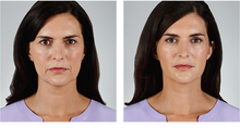 Load image into Gallery viewer, Dermal Fillers - WALK IN CLINIC PRICES**

