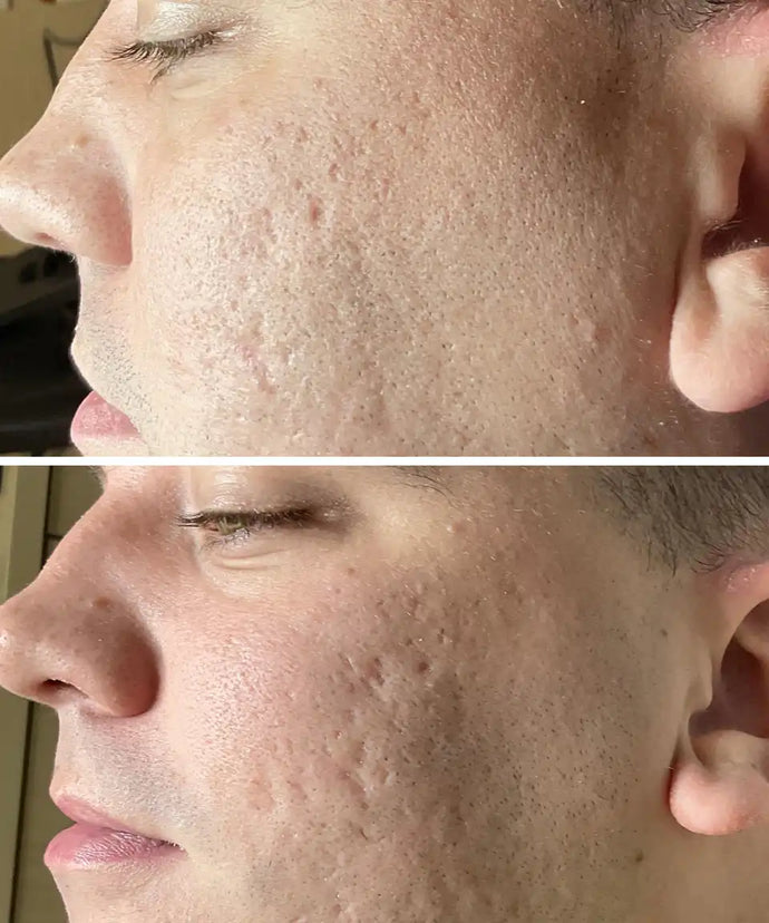 Microneedling (with or without PDGF)