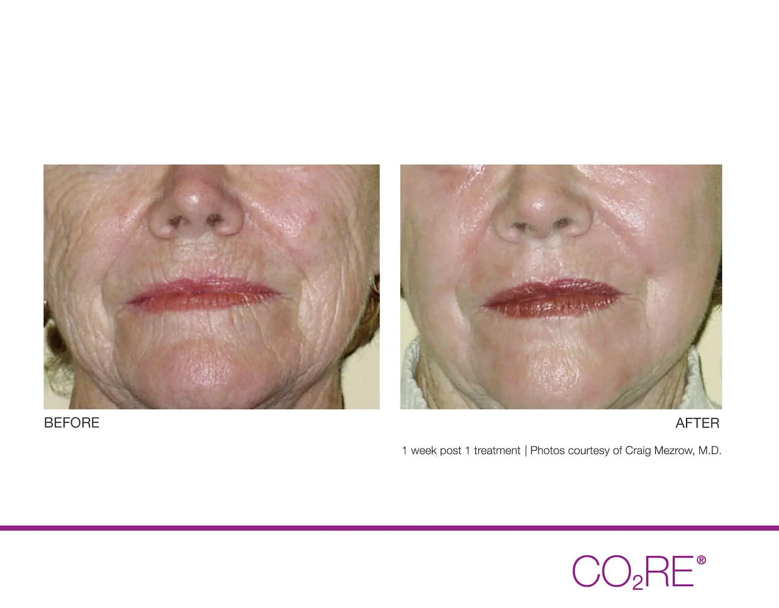 Fractional CO2 Laser Before & After - Charlotte Huntersville, NC: Saluja  Cosmetic and Laser Center