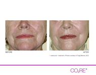 CO2 Fractional Laser Treatments