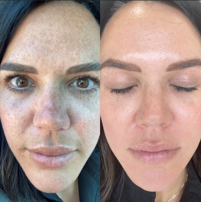 The Cosmelan® Method for Hyperpigmentation