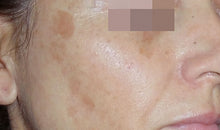 Load image into Gallery viewer, The Cosmelan® Method for Hyperpigmentation
