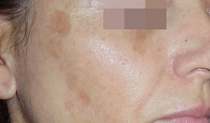 The Cosmelan® Method for Hyperpigmentation