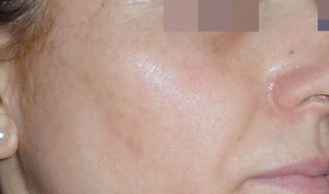 The Cosmelan® Method for Hyperpigmentation